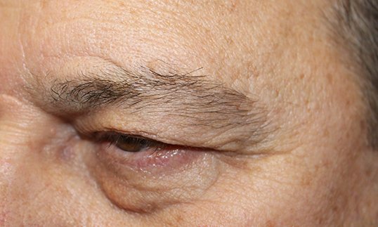 Blepharoplasty to Repair Tired Eyes Before