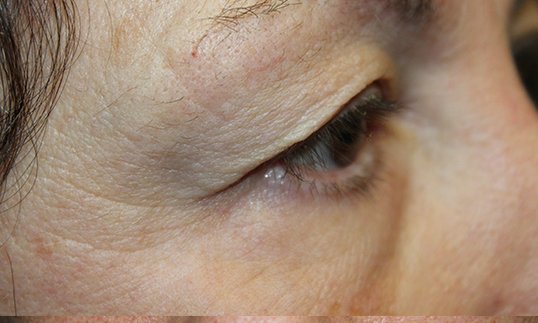 Upper Blepharoplasty to Revitalize Eyes Before