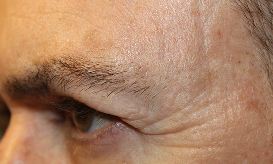 Blepharoplasty to revitalize left eye Before