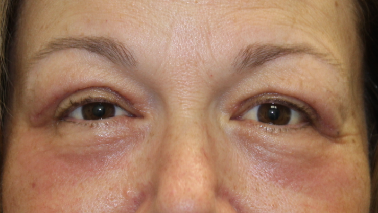 Bilateral Upper Eyelid Blepharoplasty & Bilateral Lower Eyelid Blepharoplasty W/ C02 Laser Resurfacing (Postoperative Week 1) After