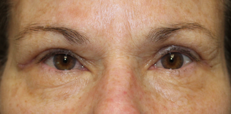 Bilateral Upper Eyelid Blepharoplasty (Postoperative Week 1) After