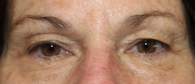 Bilateral Upper Eyelid Blepharoplasty (Postoperative Week 1) Before