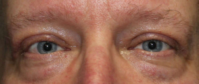 Bilateral Upper Eyelid Blepharoplasty (Postoperative Week 1) After