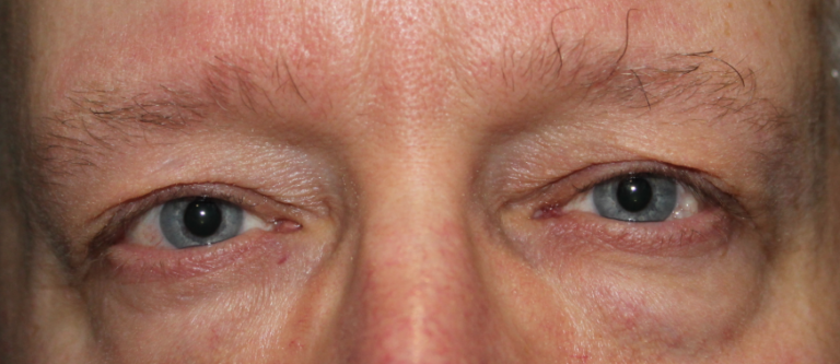 Bilateral Upper Eyelid Blepharoplasty (Postoperative Week 1) Before