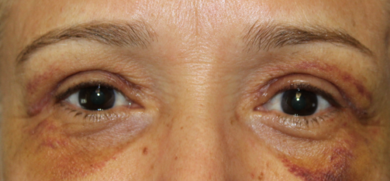 Bilateral Upper Eyelid Blepharoplasty (Postoperative Week 1) After