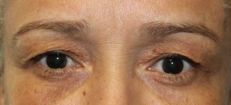 Bilateral Upper Eyelid Blepharoplasty (Postoperative Week 1) Before
