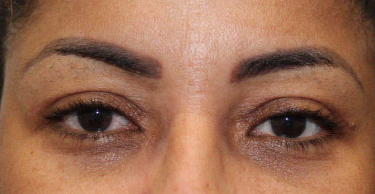 Bilateral Upper Eyelid Blepharoplasty (Postoperative Month 2) After