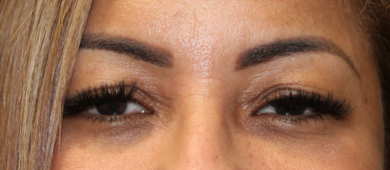 Bilateral Upper Eyelid Blepharoplasty (Postoperative Month 2) Before