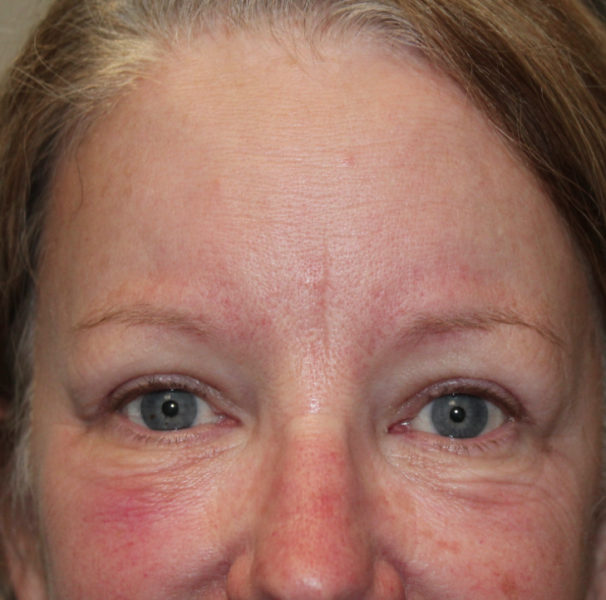 Bilateral Upper Eyelid Blepharoplasty & Bilateral Cosmetic Endoscopic Brow Lift (Postoperative Month 1) After