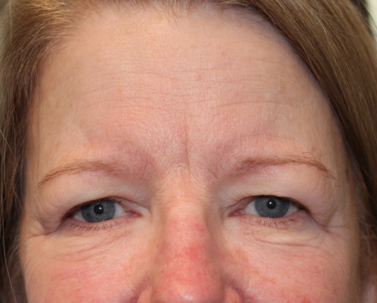 Bilateral Upper Eyelid Blepharoplasty & Bilateral Cosmetic Endoscopic Brow Lift (Postoperative Month 1) Before