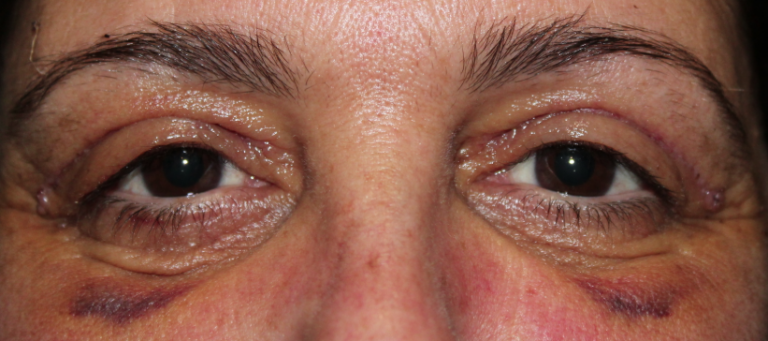 Bilateral Upper Eyelid Blepharoplasty (Postoperative Week 1) After
