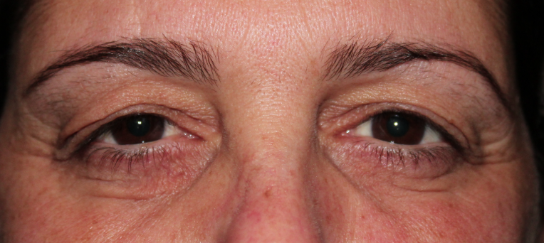 Bilateral Upper Eyelid Blepharoplasty (Postoperative Week 1) Before