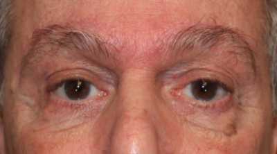 Bilateral Upper Eyelid Blepharoplasty, Bilateral Direct Brow Lift & Bilateral Lower Eyelid Blepharoplasty with Co2 laser (Post-Operative Month 3) After