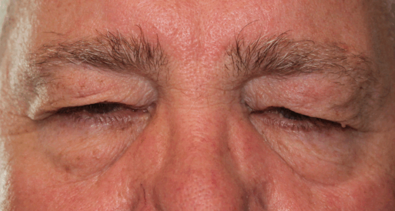 Bilateral Upper Eyelid Blepharoplasty, Bilateral Direct Brow Lift & Bilateral Lower Eyelid Blepharoplasty with Co2 laser (Post-Operative Month 3) Before
