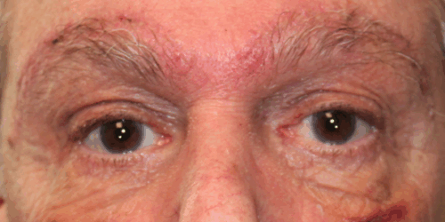 Bilateral Upper Eyelid Blepharoplasty & Bilateral Direct Brow Lift (Post-Operative Week 1) After