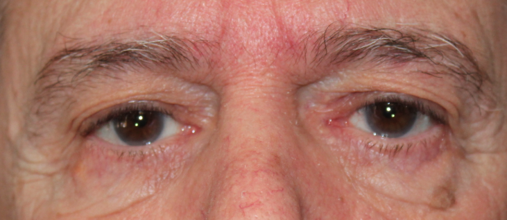 Bilateral Upper Eyelid Blepharoplasty & Bilateral Direct Brow Lift (Post-Operative Week 1) Before