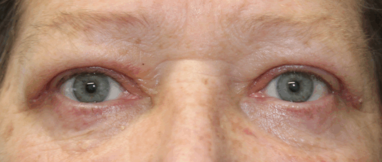 Bilateral Upper Eyelid Blepharoplasty (Post-Operative Week 1) After