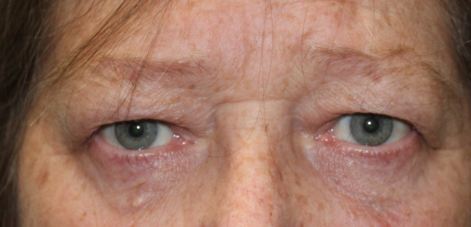 Bilateral Upper Eyelid Blepharoplasty (Post-Operative Week 1) Before