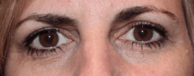 Bilateral Upper Eyelid Blepharoplasty (Post-Operative Month 2) After