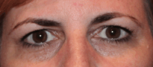Bilateral Upper Eyelid Blepharoplasty (Post-Operative Month 2) Before
