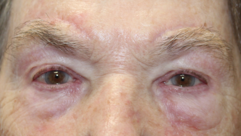 Bilateral Upper Eyelid Blepharoplasty & Bilateral Direct Brow Lift (Post-Operative Month 3) After