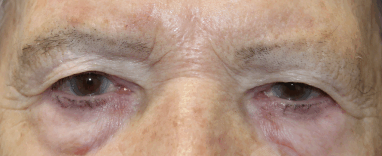 Bilateral Upper Eyelid Blepharoplasty & Bilateral Direct Brow Lift (Post-Operative Month 3) Before