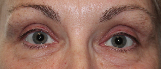 Bilateral Upper Eyelid Blepharoplasty After