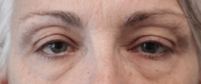 Bilateral Upper Eyelid Blepharoplasty Before