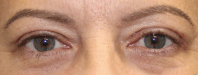 Bilateral Upper Eyelid Blepharoplasty (Post-Operative Week 2) After