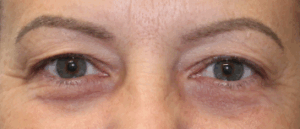 Bilateral Upper Eyelid Blepharoplasty (Post-Operative Week 2) Before