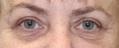 Bilateral Upper Eyelid Blepharoplasty (Post-Operative Month 3) After