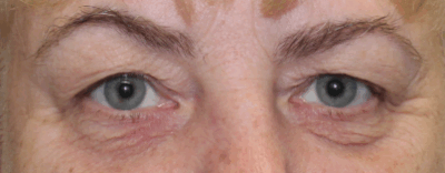 Bilateral Upper Eyelid Blepharoplasty (Post-Operative Month 3) Before