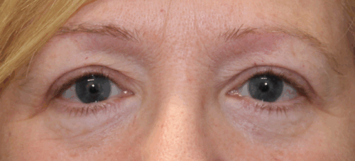 Bilateral Upper Eyelid Blepharoplasty with Crease Elevation (Post-Operative Month 2) After