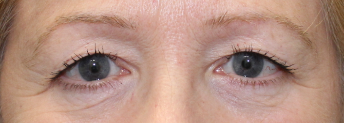 Bilateral Upper Eyelid Blepharoplasty with Crease Elevation (Post-Operative Month 2) Before