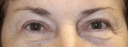 Left Upper Eyelid Blepharoplasty (Post-Operative Month 3) After