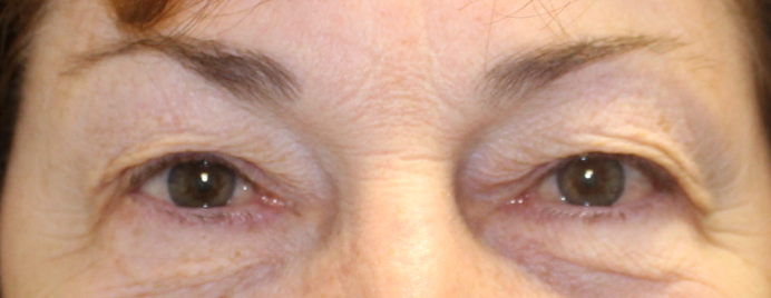 Bilateral Upper Eyelid Blepharoplasty (Post-Operative Month 3) Before