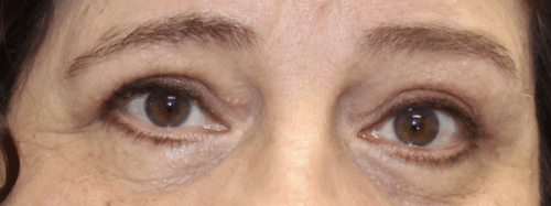 Bilateral Upper Eyelid Blepharoplasty (Post-Operative Month 2) After