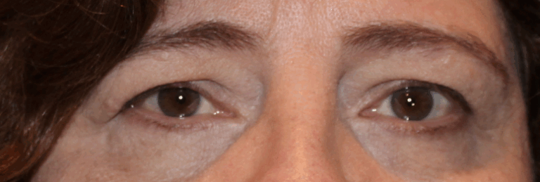 Bilateral Upper Eyelid Blepharoplasty (Post-Operative Month 2) Before