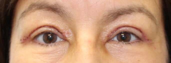 Bilateral Upper Eyelid Blepharoplasty (Post-Operative Day 5) After