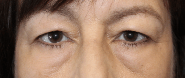 Bilateral Upper Eyelid Blepharoplasty (Post-Operative Day 5) Before