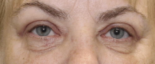 Bilateral Upper Eyelid Blepharoplasty (Post-Operative Week 1) After