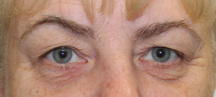 Bilateral Upper Eyelid Blepharoplasty (Post-Operative Week 1) Before