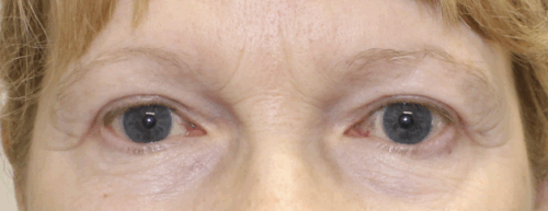 Bilateral Upper Eyelid Blepharoplasty (Post-Operative Month 2) After