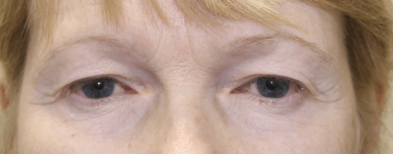Bilateral Upper Eyelid Blepharoplasty (Post-Operative Month 2) Before