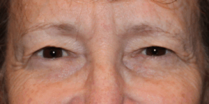 Bilateral Upper Eyelid Blepharoplasty (Post-Operative Month 2) Before