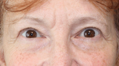 Bilateral Upper Eyelid Blepharoplasty (Post-Operative Month 2) After