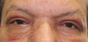Bilateral Upper Eyelid Blepharoplasty (Post-Operative Week 1) After