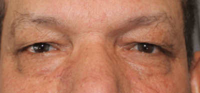 Bilateral Upper Eyelid Blepharoplasty (Post-Operative Week 1) Before