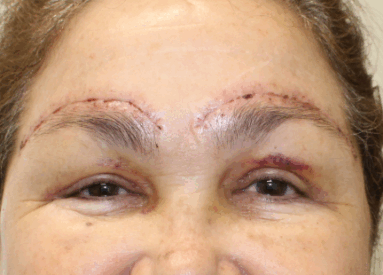 Bilateral Upper Eyelid Blepharoplasty & Bilateral Direct Brow Lift (Post-Operative Week 1) After