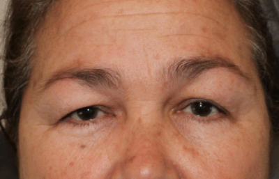 Bilateral Upper Eyelid Blepharoplasty & Bilateral Direct Brow Lift (Post-Operative Week 1) Before